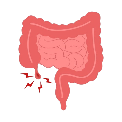 Appendectomy