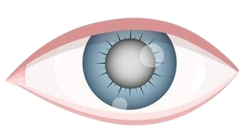 Cataract