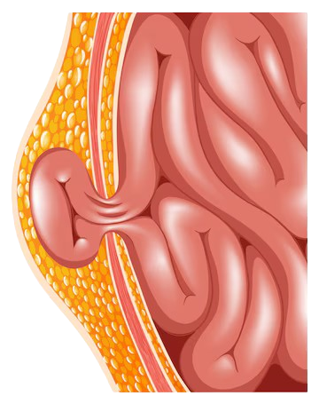 Hernia