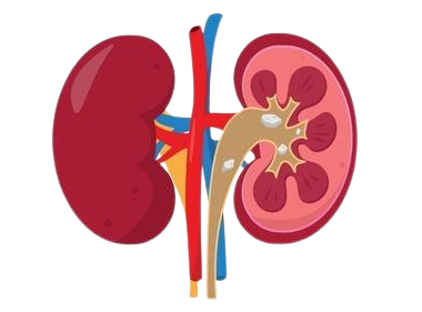 Kidney Stone